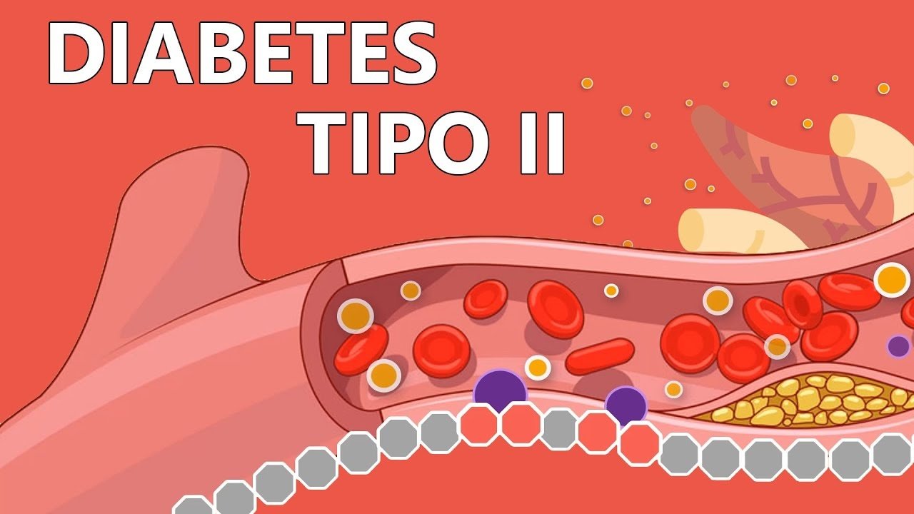 Especialistas favorecen dietas bajas en carbohidratos para pacientes con diabetes tipo 2